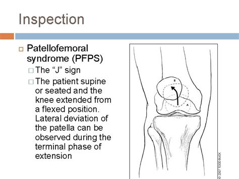 patellofemoral syndrome exam findings